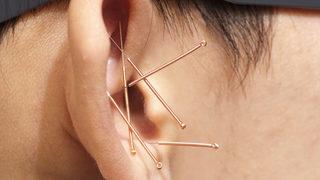 Akupunktur yöntemiyle nasıl zayıflanır? Diyete ve spora gerek var mı?