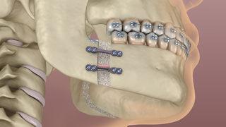 Çene implantı nedir? Çene implantı sonrası ağız bakımı nasıl olur?