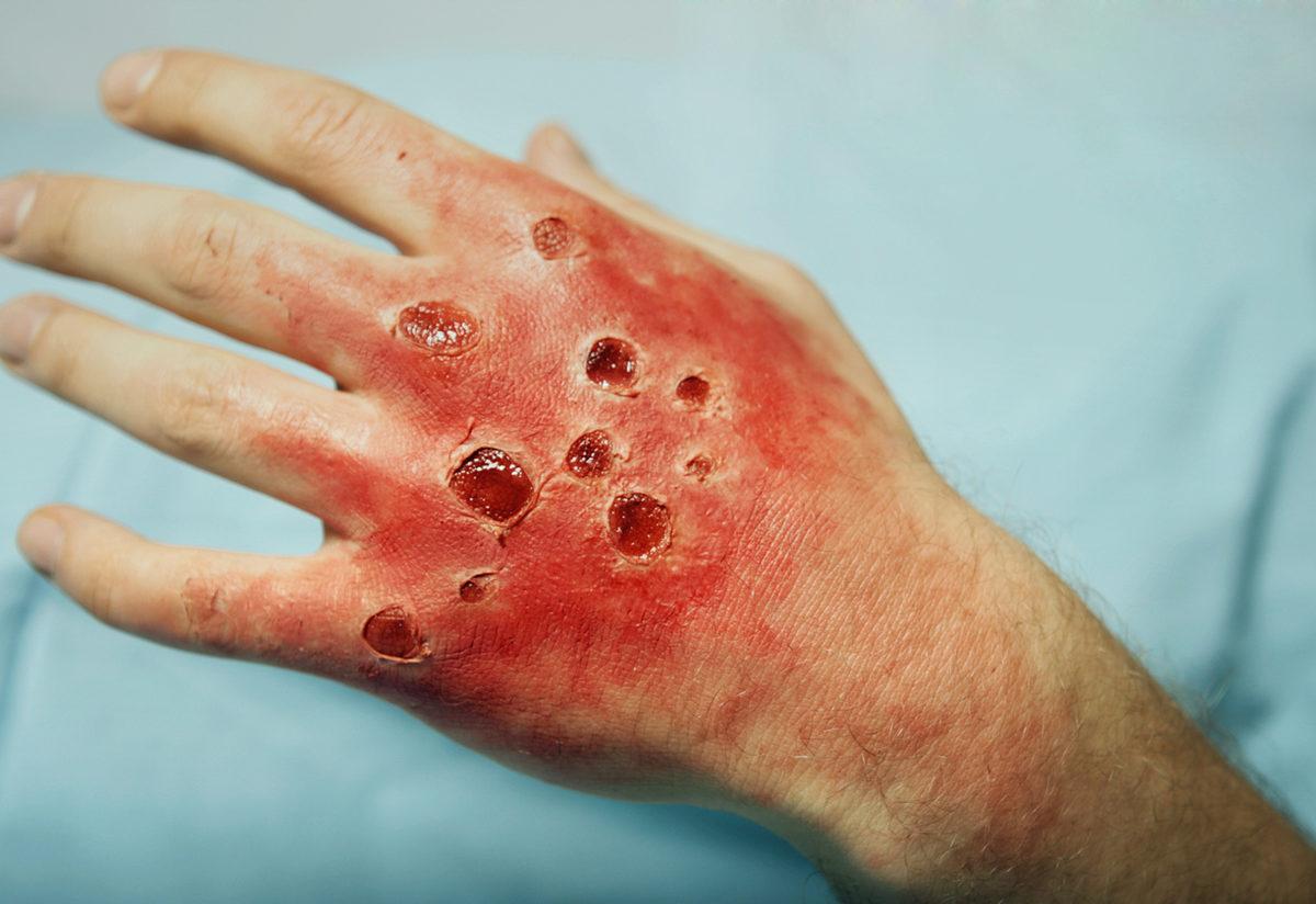 yanik derecelerinden en agiri hangisi yanik cesitleri ve tedavi yontemleri saglik haberleri yanik derecelerinden en agiri hangisi yanik cesitleri ve tedavi yontemleri saglik haberleri