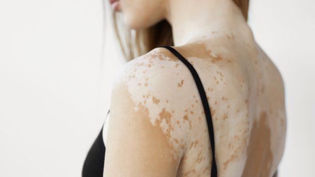 B12 vitamini eksikliğine dikkat! Vitiligo belirtilerinden sadece biri
