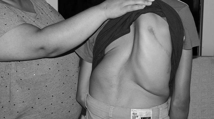 Uzman isim açıkladı: Skolyoz hastalığı son 10 yılda arttı