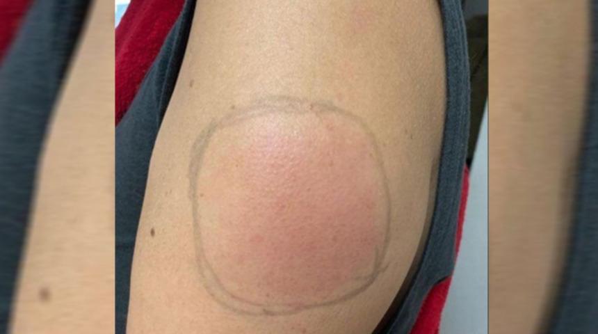 Moderna aşısında yan etki: Kovid-19 Kolu