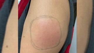 Moderna aşısında yan etki: Kovid-19 Kolu