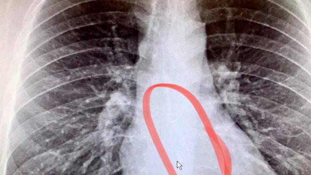 Boğaz kuruluğu nedeniyle doktora başvurdu, içinden kulaklık çıktı!