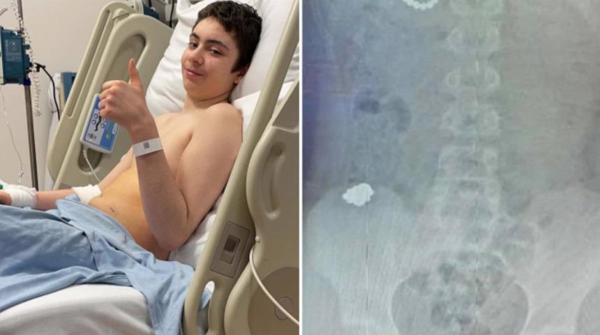 İngiltere'de bir çocuğun midesinden 54 bilye çıktı!