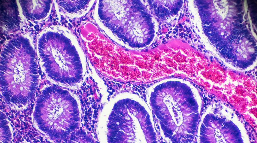 Polip taraması ile kolon kanserini önleyebilirsiniz! 