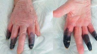 İtalya’da koronavirüs hastası kadın kangren oldu, 3 parmağı kesildi