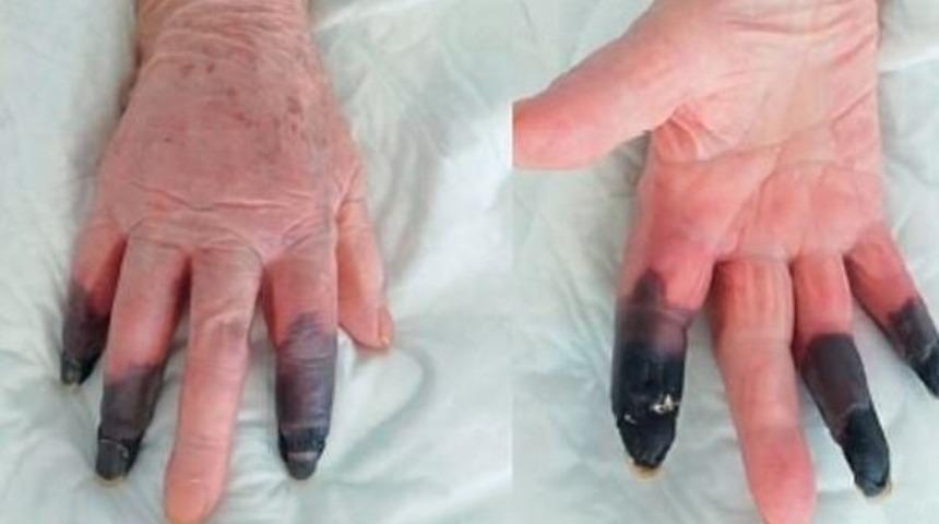İtalya’da koronavirüs hastası kadın kangren oldu, 3 parmağı kesildi