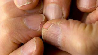 Tırnak kırılmasının altında yatan nedenler! Tırnak etlerinizi kesiyorsanız eğer...