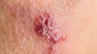 Geçti sanmayın yıllarca uykuda yaşayabilir! Zona hastalığı akupunkturla tamamen geçer mi?