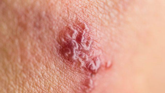 Geçti sanmayın yıllarca uykuda yaşayabilir! Zona hastalığı akupunkturla tamamen geçer mi?