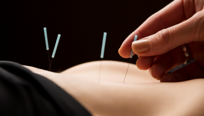 İğnenin ucundaki şifa! Akupunktur yöntemiyle adet düzensizliği nasıl tedavi edilir?