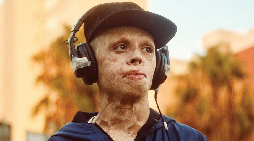 8 yaşında vücudunun yüzde 90'ı yanan genç: Kaza sonrası ölümden çok hayattan korkuyorum