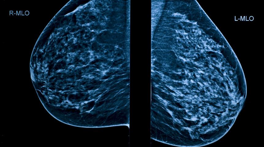 Meme dikleştirme estetiği sarkan göğüs sorununu ortadan kaldırıyor!