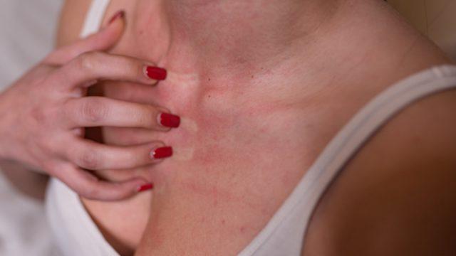 Hipnozla cilt rahatsızlıkları tedavi edilebilir mi? Kişi trans haline girerek...