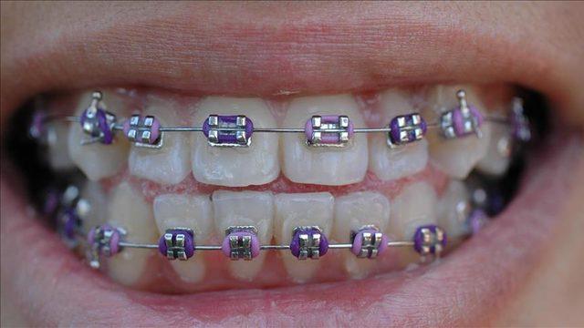 ortodonti tedavisi diş teli