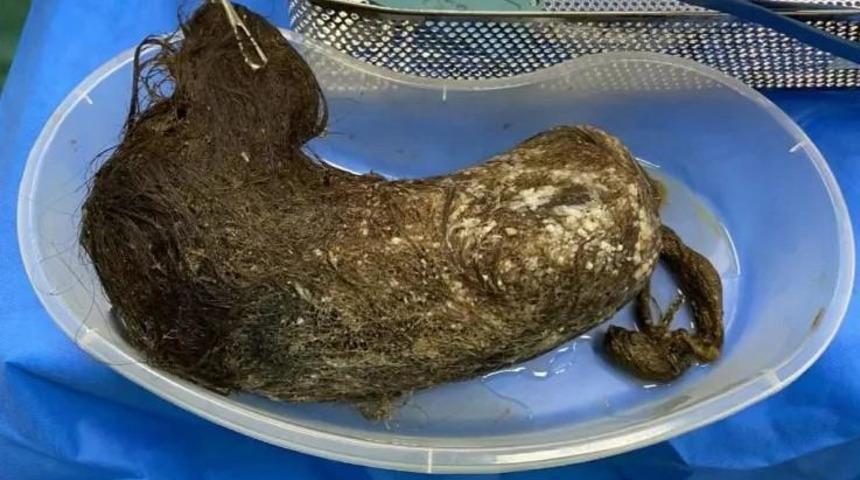 İç organlarında biriken dev saç yumağı midesinin yırttı