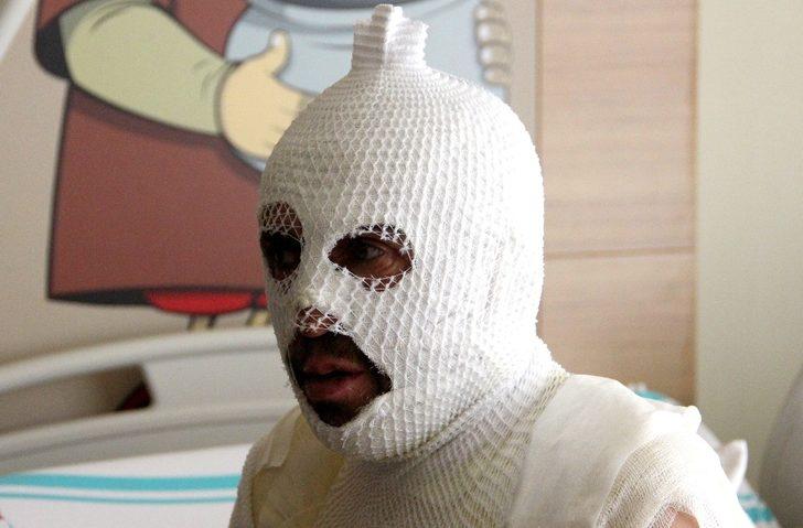 Akrabaları tarafından kaynar suyla yakıldığını iddia etti G5