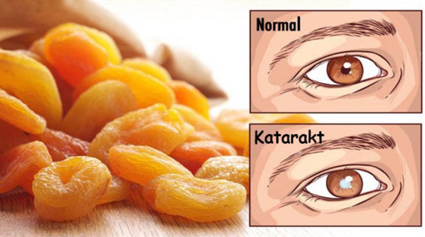 Katarakt Hastalığından Kurtulmanın En Basit Yolu!