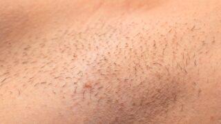 Cımbız ve ağdadan kaçış yolu lazer epilasyon! Deri ve kıl renginiz uygunsa...