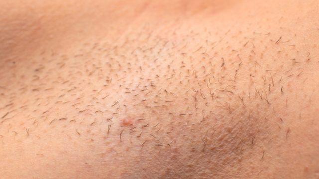 Cımbız ve ağdadan kaçış yolu lazer epilasyon! Deri ve kıl renginiz uygunsa...