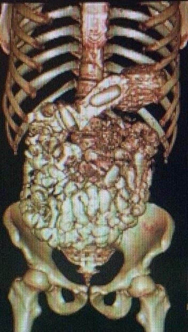 Midesinde uyuşturucu sevkiyatı yapan 2 kişi, polisin dikkati sayesinde yakalandı G5