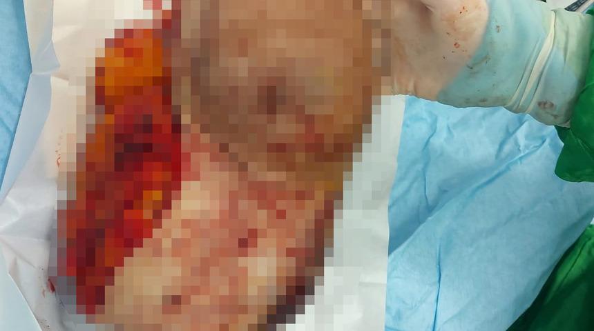 Memesinden 4,5 kiloluk kitle çıkarıldı