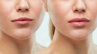 Dudak dolgunlaştırma işleminde dikkat etmeniz gerekenler: Morarma ve kanama olursa...