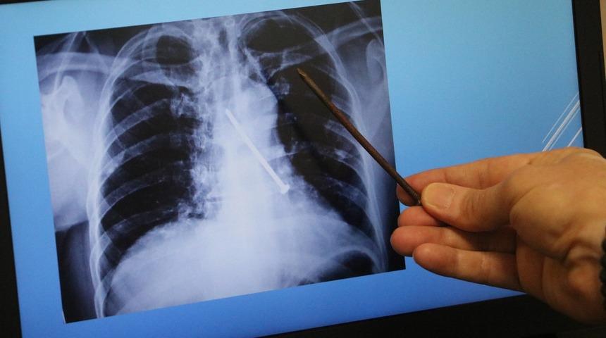 Hepsi insan vücudundan çıkartıldı! Çivi bile var