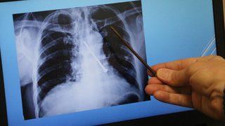 Hepsi insan vücudundan çıkartıldı! Çivi bile var