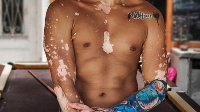 Vitiligo hastası olan ünlü model Roger Monte sosyal medyada ilham kaynağı oldu! 