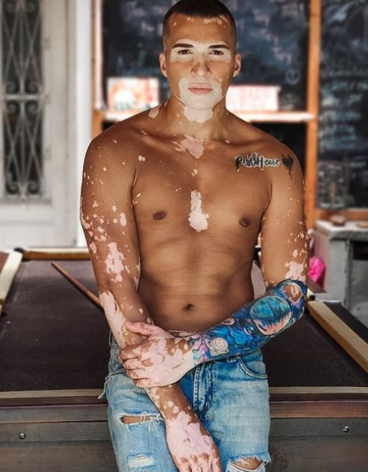 Vitiligo hastası olan ünlü model Roger Monte sosyal medyada ilham kaynağı oldu! 