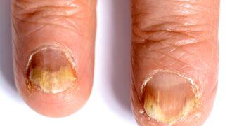 3 etkene dikkat! Ayak tırnağındaki mantar tedavi edilmezse bulaşıyor, enfeksiyon...