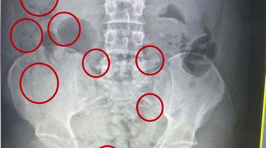 Röntgende fark edildi! Mide ve bağırsaklarından uyuşturucu çıkarıldı