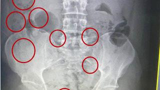 Röntgende fark edildi! Mide ve bağırsaklarından uyuşturucu çıkarıldı