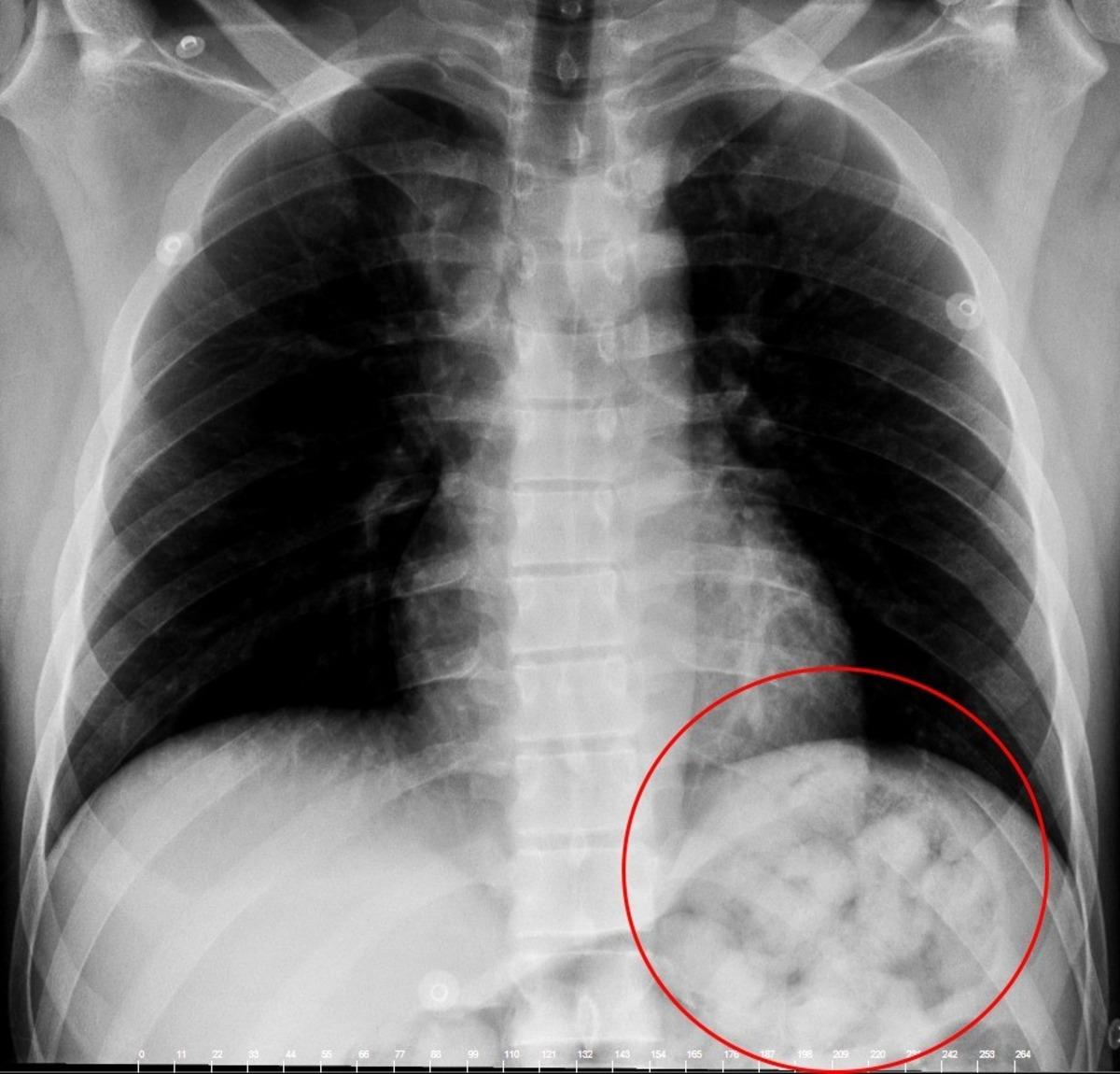 Karnından uyuşturucu zulası &ccedil;ıktı