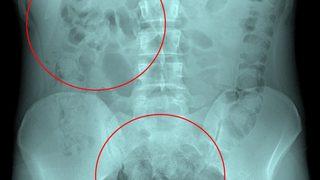 Otogarda fenalaşan İranlı yolcunun midesinden 890 gram uyuşturucu çıktı