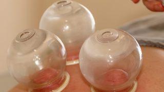 Uzmanından hacamat uyarısı: Hastalıklara şifa aranıyor ama...