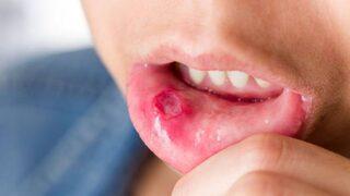 Behçet hastalığı nedir? İşte belirtileri ve tedavi yöntemi…