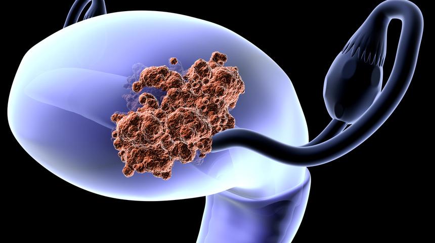 Uzmanlardan rahim kanseri uyarısı! Menopoz sonrasında ortaya çıkıyor, sayı hızla artıyor