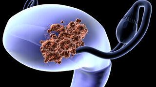 Uzmanlardan rahim kanseri uyarısı! Menopoz sonrasında ortaya çıkıyor, sayı hızla artıyor