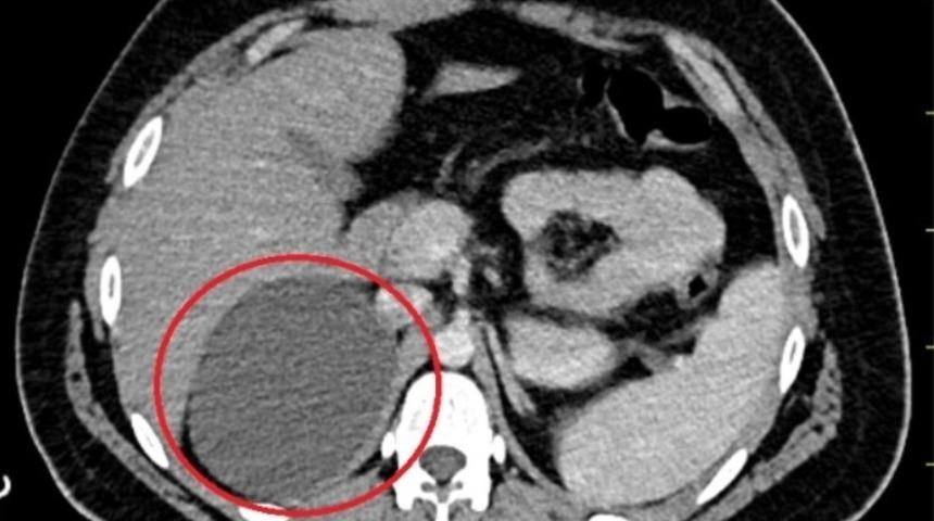 Böbreküstü bezinden 11 santimetrelik kitle çıkarıldı! 1 gün sonra taburcu edildi
