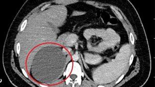 Böbreküstü bezinden 11 santimetrelik kitle çıkarıldı! 1 gün sonra taburcu edildi