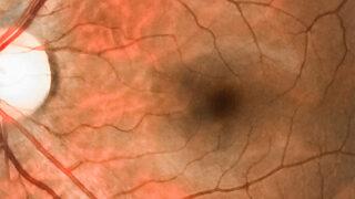 Göz tansiyonu uyarısı: Erken tanı hayat kurtarıyor!