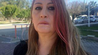 Estetik uğruna dudağını kaybetmişti! 'Hayatım durdu, ruh sağlığım bozuldu'