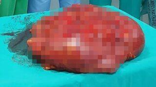 Gaz şikayetiyle gitti, karnından 21 kilo tümör çıkarıldı!