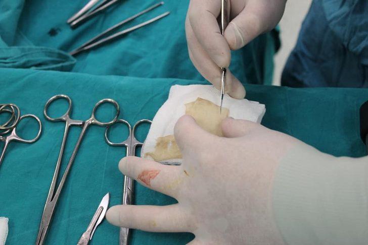 Yozgat Şehir Hastanesinde deri greftlemesi tekniği uygulandı G3