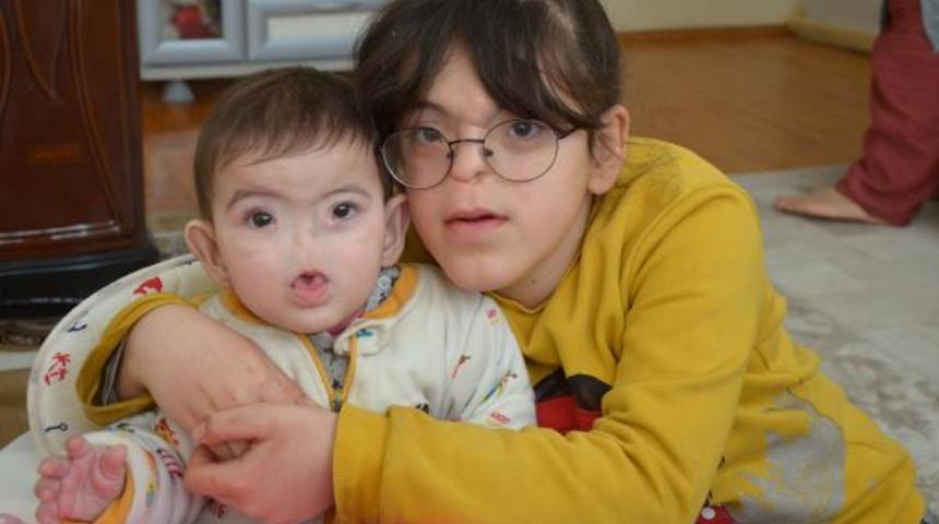 Dünyada 13, Türkiye'de ise 4 kişide var! 2 kardeş de burunsuz dünyaya geldi