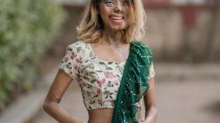 Öz babasının asitli saldırısına uğradıktan sonra yüzünü kaybeden Anmol Rodriguez, sosyal medyada fenomen oldu