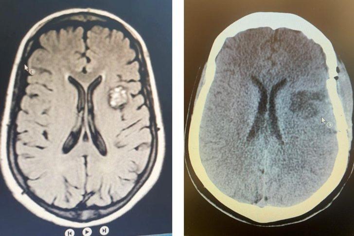 BAÜN Hastanesi’nde riskli beyin ameliyatı başarıyla yapıldı G2
